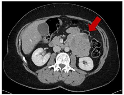 Trabectedin and Radiation Therapy for Cardiac Metastasis From Leiomyosarcoma: A Case Report and Review of the Literature